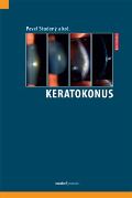 kolektiv autorů Keratokonus
