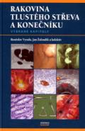 Maxdorf Rakovina tlustého střeva a konečníku - vybrané kapitoly