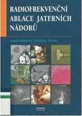 Maxdorf Radiofrekvenční ablace jaterních nádorů