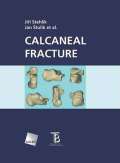 Galn Calcaneal fracture