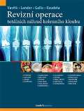 Maxdorf Revizní operace totálních náhrad kolenního kloubu